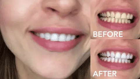 ✨TEETH WHITENING -  Blanqueamiento Natural 🌿 🦷